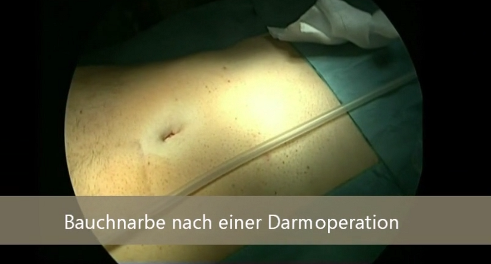 Videostandbild: Laparoskopische Verwachsungslösungen nach einer Bauchoperation